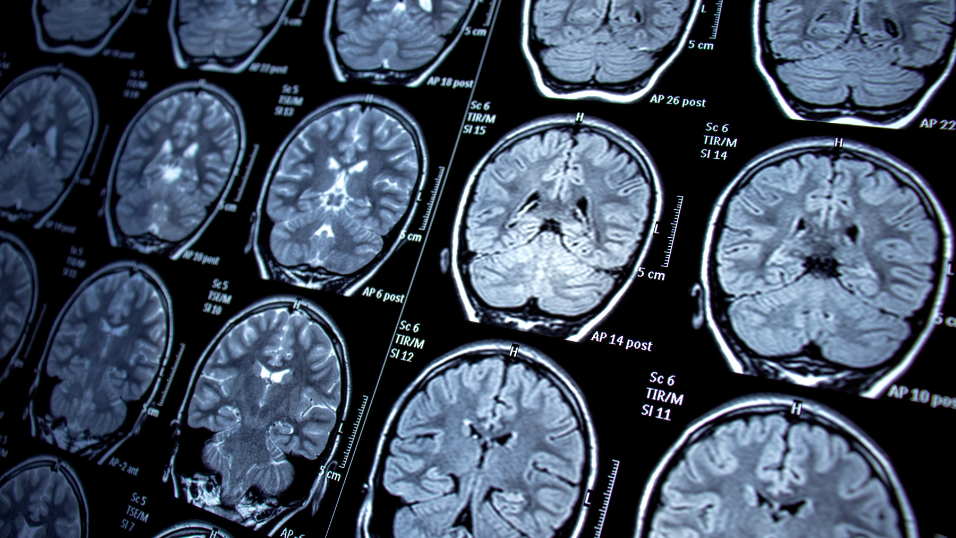Jazz Pharmaceuticals to Acquire Actio Biosciences in a Deal Worth Up to $1.32 Billion, Adding a Rare Epilepsy Drug Candidate