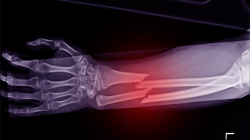 West Chester’s Meduloc Closes $4 Million Series B to Launch Its Flexible Fracture Fixation Device