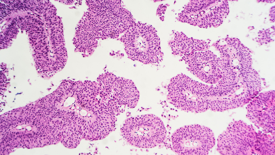 UroGen Invests Up to $7 Million in IntraGel to Expand Beyond Urothelial Cancer