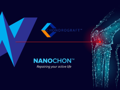 Baltimore’s Nanochon Treats First Patient in Chondrograft™’s First-in-Human Trial