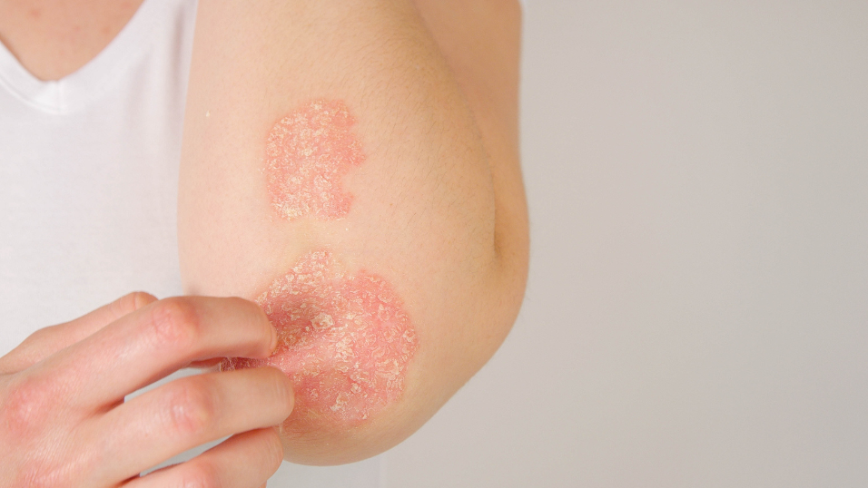 DC’s Vanda Pharmaceuticals Wins EU Orphan Status for Its Rare Skin Disease Drug